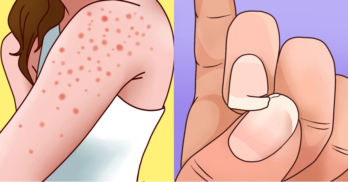 Celiac Disease Symptoms – Gluten Reaction Signs In Adults