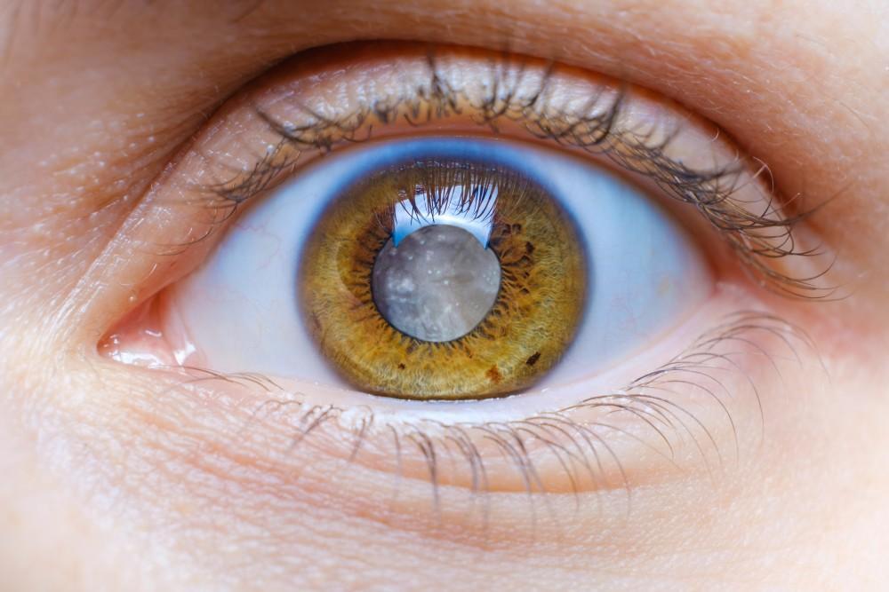 Cataract Symptoms: Cloudy, Blurry Vision That Gradually Worsens