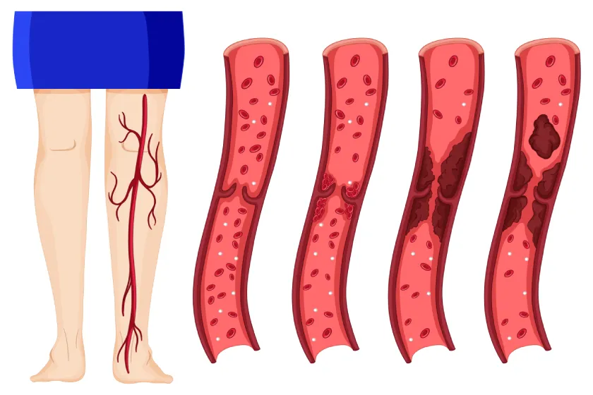 Deep Vein Thrombosis Symptoms – Leg Clot Warning Signs