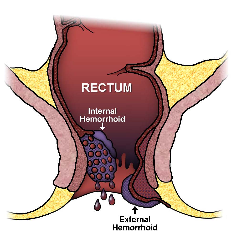 Hemorrhoids Symptoms: Pain, Bleeding, Itching, and Swelling