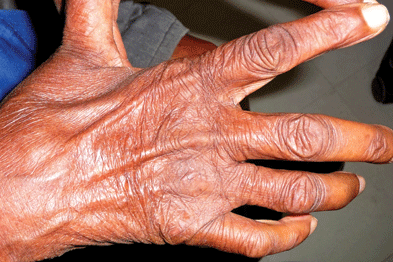 Leprosy Symptoms – Skin Patches, Numbness and Nerve Damage
