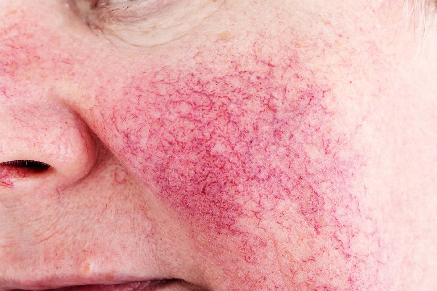 Rosacea Symptoms: Facial Redness, Sensitive Skin, and Common Triggers