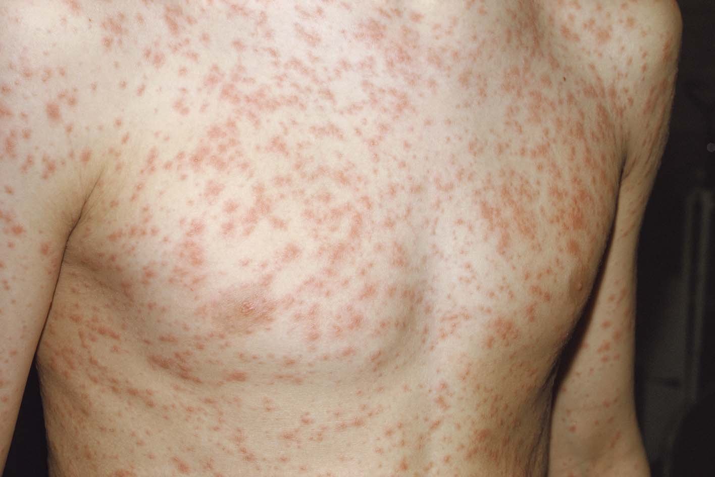 Rubella Symptoms: Mild Rash With Serious Pregnancy Risks