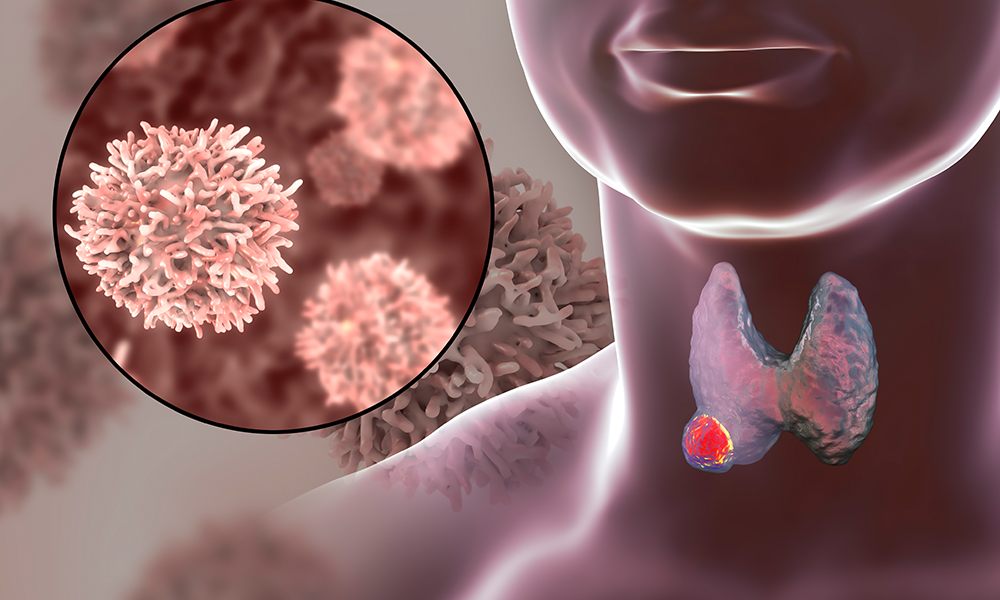 Thyroid Cancer Symptoms – Neck Lump And Voice Changes