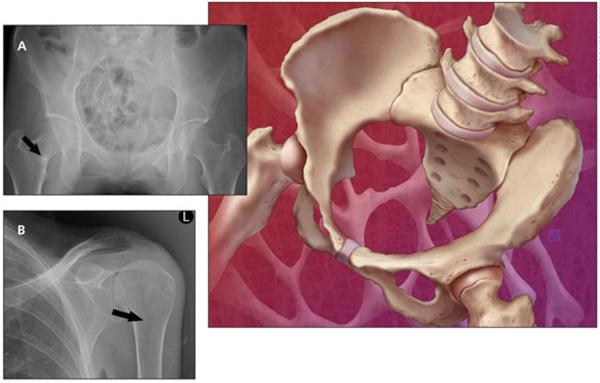 Vitamin D Deficiency Symptoms – Bone Pain And Constant Tiredness
